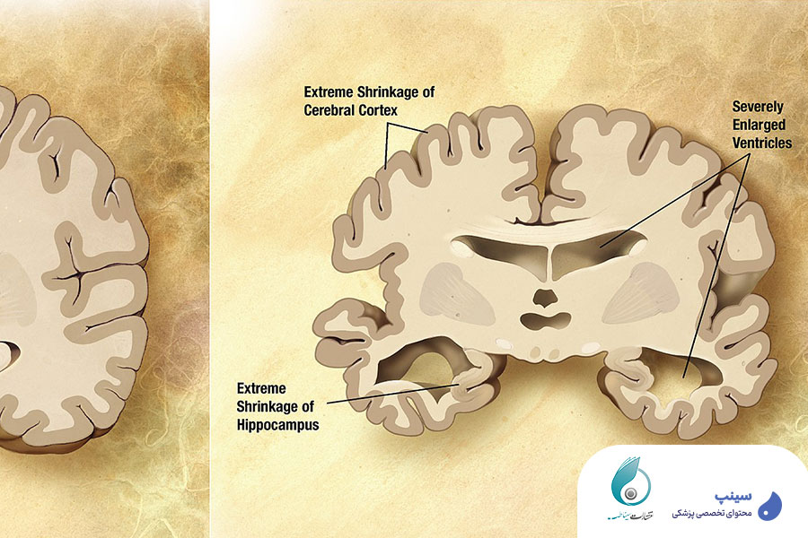 علائم بیماری دمانس زوال عقل