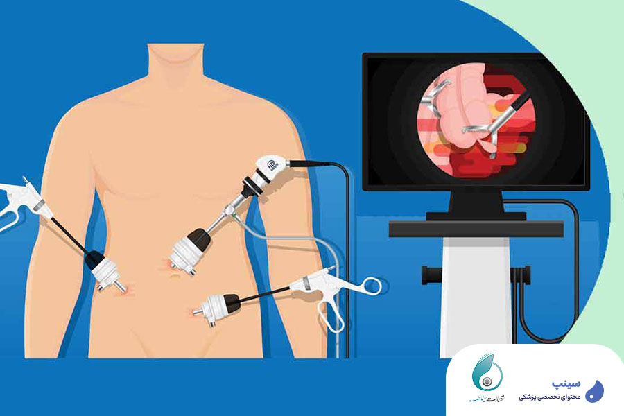 لاپاراسکوپی بهتره یا عمل باز