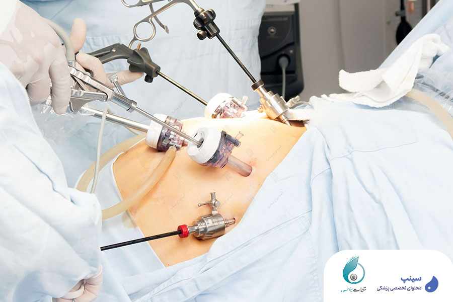 مراحل انجام جراحی کولکتومی