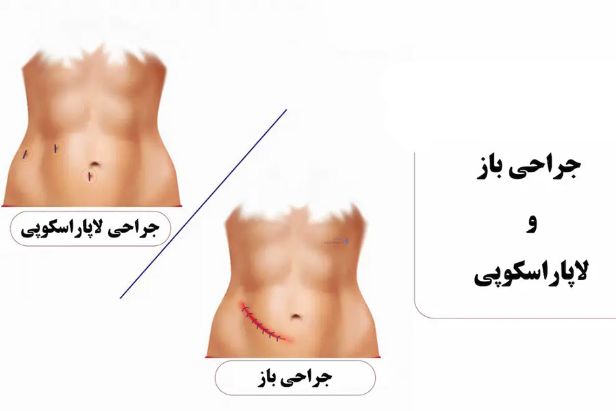 مقایسه لاپاروسکوپی با جراحی باز